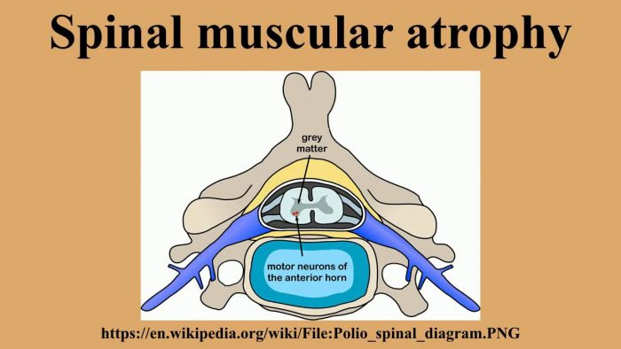 spinal muscular atrophy