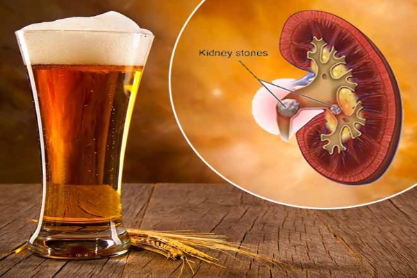 beer kidney stone