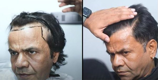 rajpal yadav hair transplant