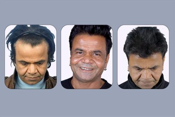 rajpal yadav hair transplant